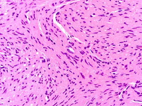 Solitary Intraosseous Mandibular Neurofibroma: Clinical Case Study