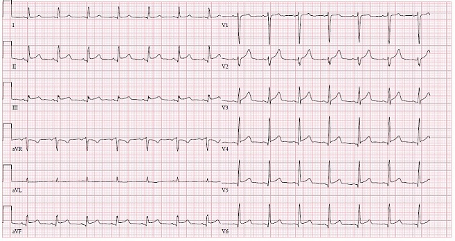 Acute Coronary Syndrome versus Takotsubo Cardiomyopathy: A Diagnostic Dilemma