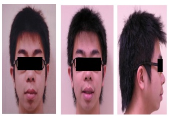 ISW for the Treatment of Bilateral Posterior Buccal Crossbite