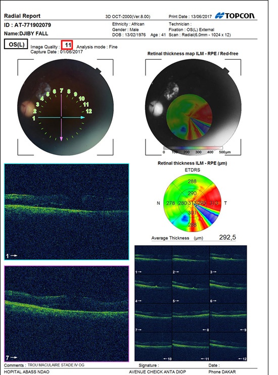 Macular Hole Association and Behcets Disease