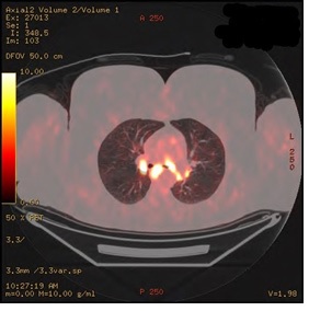 Neurosarcoidosis Characterized by Necrotizing Granulomas: The Challenges and Pitfalls of Diagnosing Neurosarcoidosis