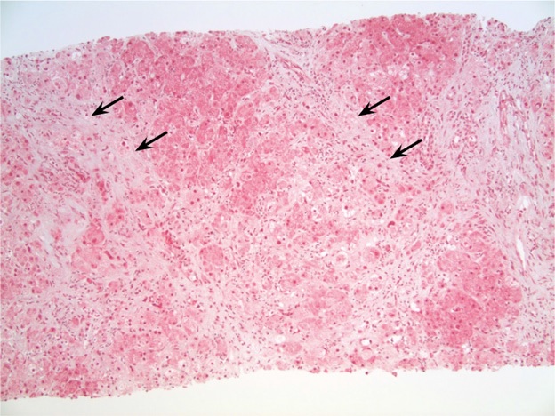 Severe Hepatic Toxicity with Portal Hypertension: An Unusual but Preventable Complication of Amiodarone Therapy