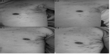 Treatment of Metastatic Sweat Gland Carcinomas: Response in Two Cases