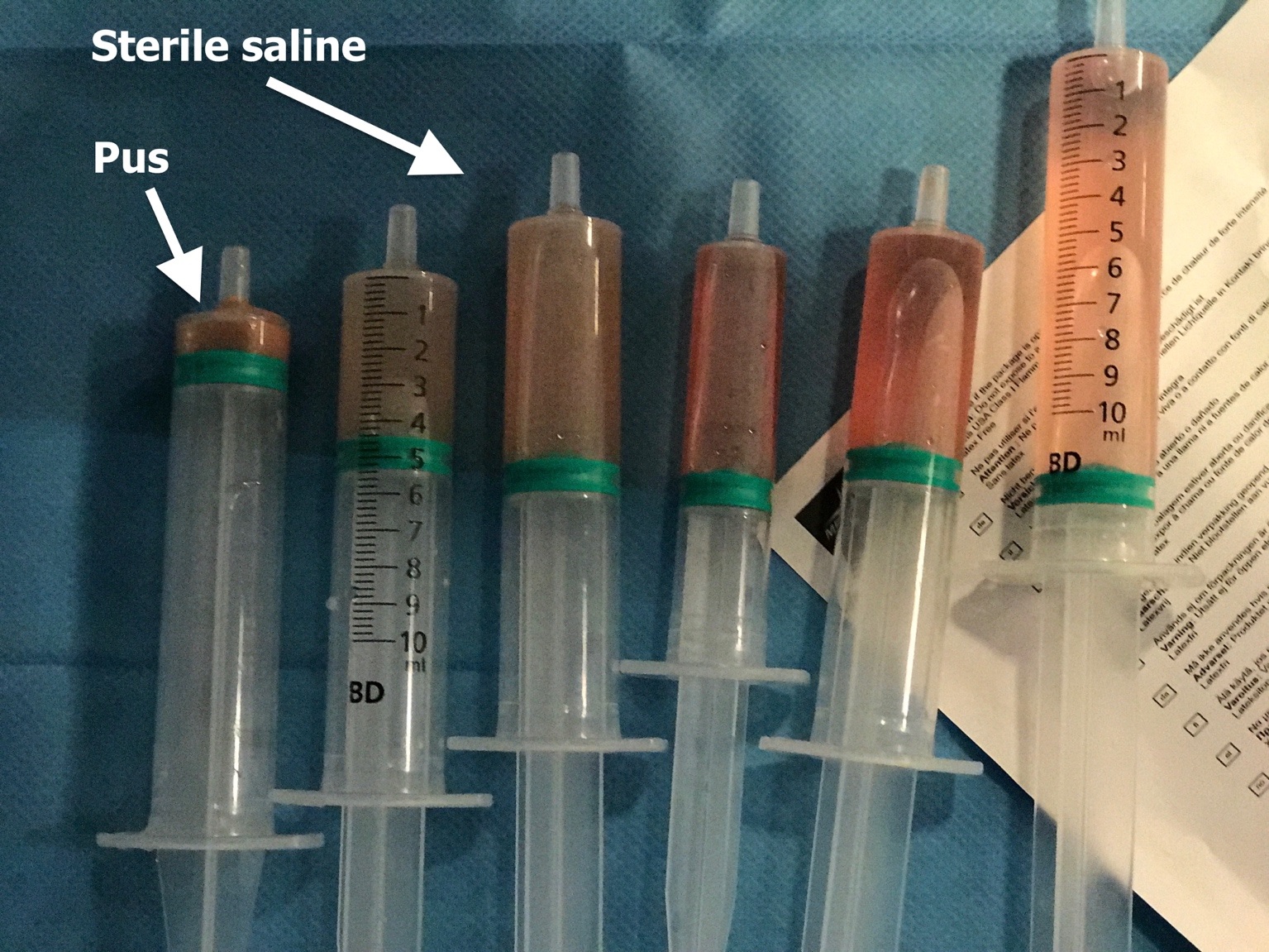 Ultrasound-Guided Evacuation of A Perineural Abscess: Illustrating Anesthesi- ologist’s Skills Beyond Anesthesia Practice