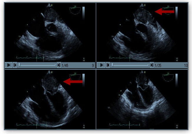 Primary Leiomyosarcoma of the Left Atrium