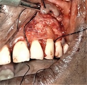 Amniotic Membrane as Barrier Membrane in Endo-Perio Lesion – A Interdisci- plinary Approach