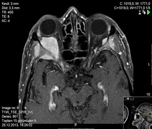 Rare Seen Bilateral Orbital Chloroma