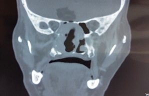 Solitary Fibrous Tumor of Nasal Cavity with Intracranial Extension