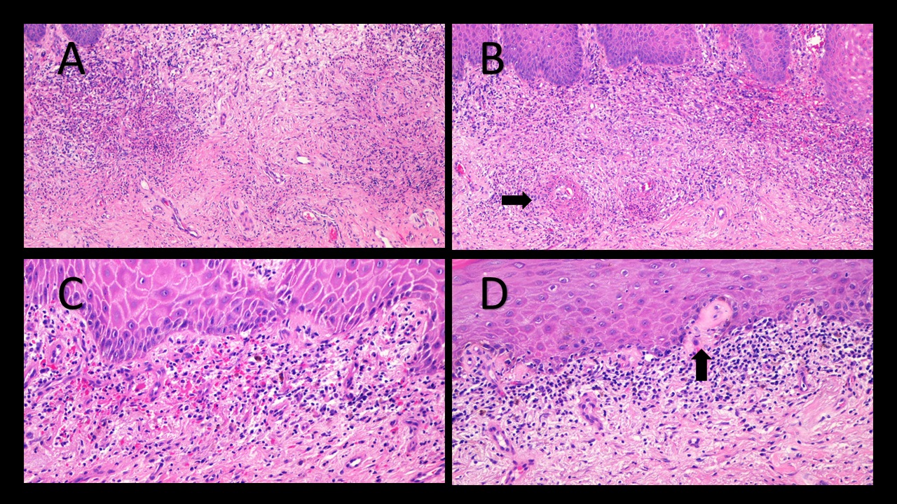 First Case Report of Erythema Elevatum Diutinum Involving the Glans Penis of A HIV–Positive Patient: Possible Atypical Manifestation of Immune Reconstitution Inflammatory Syndrome