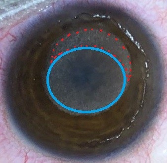 Early Postoperative Topographic changes after laser Asymmetric Keratectomy for the Management of Adverse Effects after Photorefractive Keratectomy