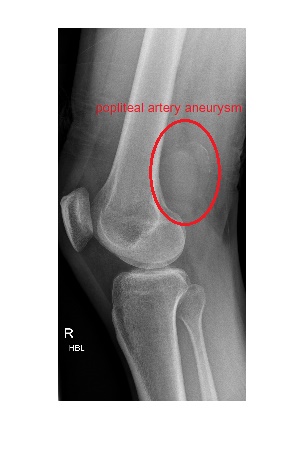 The -94Ins/DelATTG Promoter Polymorphism in the Transcription Factor NF-Kb in Patients with Popliteal Aneurysm