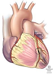 The Effect of Saphenous Vein Closure on Myocardial Ischemia