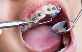 Sociodemographic Characteristics of Orthodontic Patients in Association with Diagnosis, Adherence and Treatment Duration in Lugalo Military Hospital, Dar Es Salaam Tanzania
