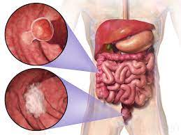 Age of Less than Forty Years Seems Not Be an Independent Factor for Poor Prognosis in Patients Undergoing Surgery for CRC