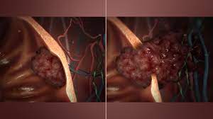 Immature Teratoma and Teratoma Associated with Associated with Malignancies, Clinicopathological and Survival Outcome at AHPGIC