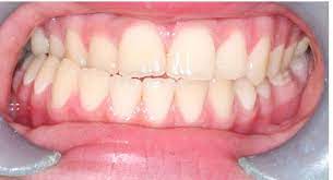 A comprehensive Management of Unusual Presentation of A Supernumerary Tooth Causing Anterior Cross Bite In Mixed Dentition – Case Report