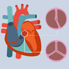 Emergency Transcatheter Aortic Valve Implantation in A Patient with The Assistance of Intra-Aortic Balloon Pump