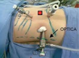 Describe the Novel & Convenient Technique for the Insertion of Double J Stent after Laparoscopic Ureterolithotomy – How I Do It