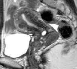 Utilization and Perceptions of a Novel Cervical Visualization Tool, The Callascope, For Home-Based Self-Cervical Examinations