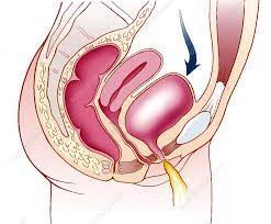 Evaluation of Electromagnetic Therapy on The Pelvic Floor as an Alternative Treatment for Stress Urinary Incontinence