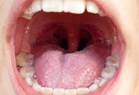 The Role of Tumor Necrosis Factor-alpha (TNF-α) in the Pathogenesis of Oral Diseases