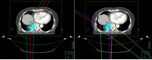 Improving Radiotherapy Plan Quality Through Independent Physics Pre-Review